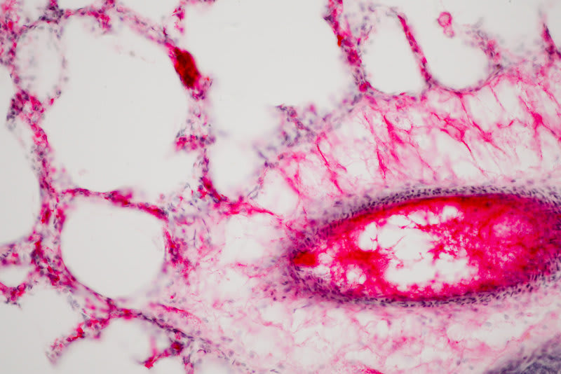 CRISPR corrige mutación de fibrosis quística