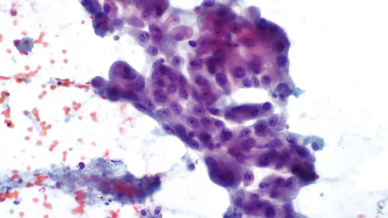 Dos combinaciones prolongan la supervivencia en cáncer EGFR