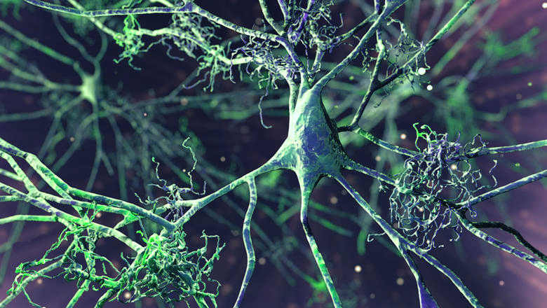 Fármaco oncológico revierte fase temprana del Alzheimer