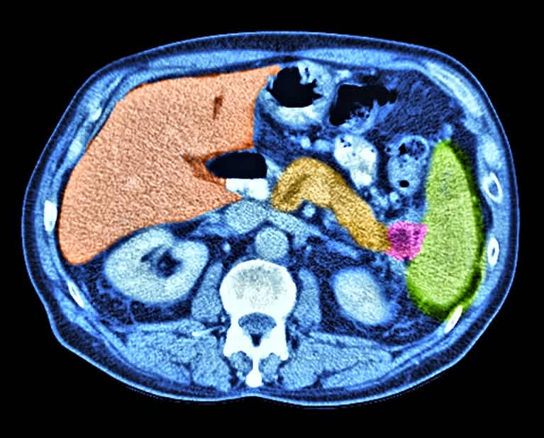 IA detecta cáncer de páncreas 475 días antes del diagnóstico