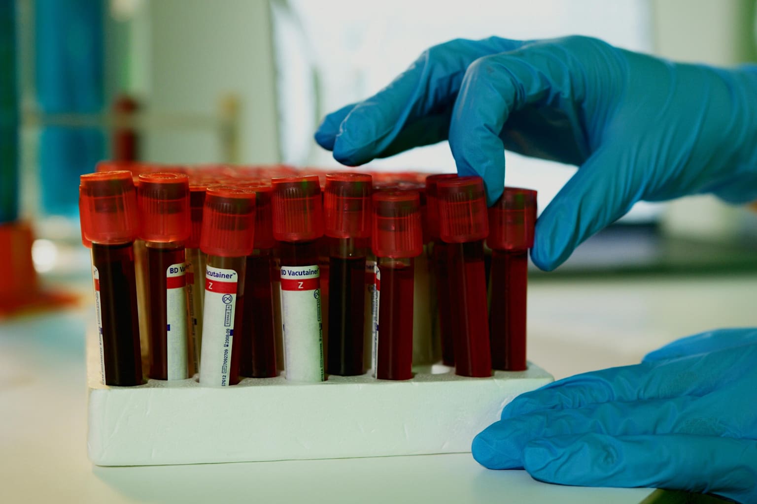 IA predice éxito de inmunoterapia en análisis de sangre