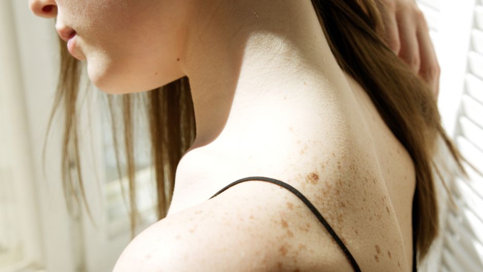 Imagen en primer plano del hombro con pecas de una mujer iluminado con gracia por la luz del sol.
