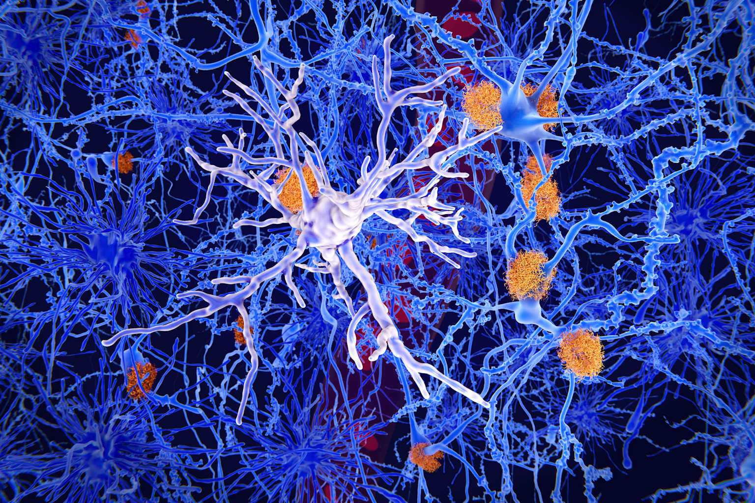 Mutaciones de cáncer en la sangre impulsan el Alzheimer