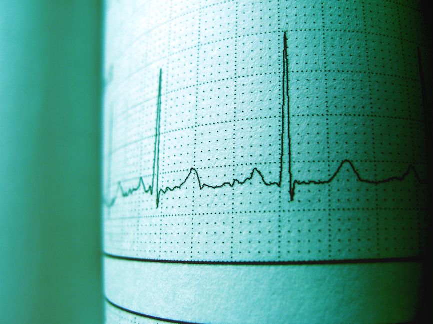 Acercamiento de una impresión de ECG que muestra el ritmo y la frecuencia del latido para análisis médico.
