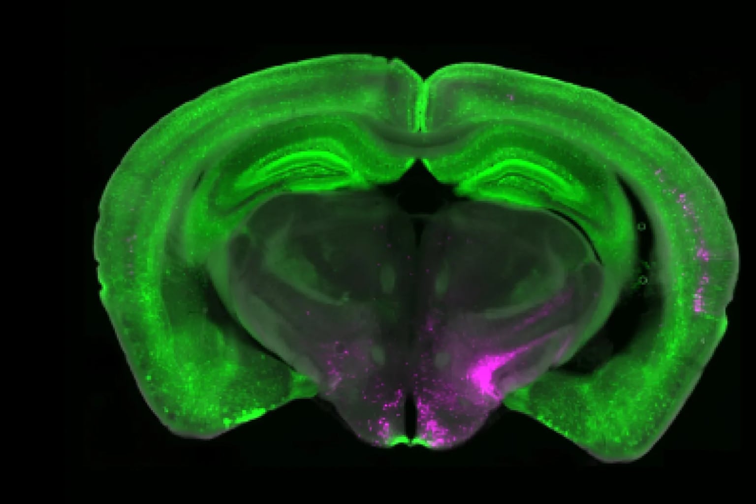 Stanford mapea el circuito exacto del dolor crónico